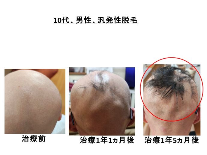 円形脱毛症　病院
